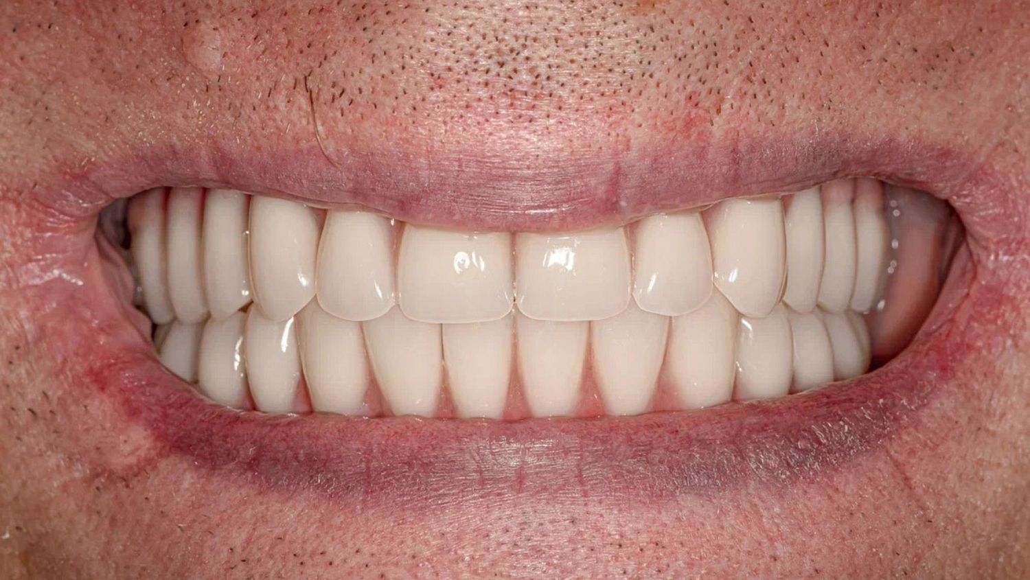 Имплантация зубов all-one-4