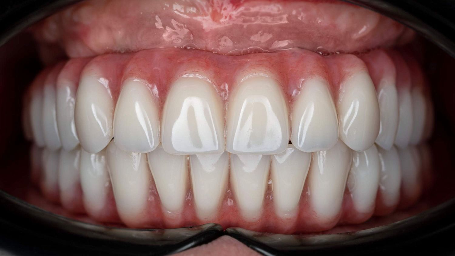Имплантация зубов all-one-4